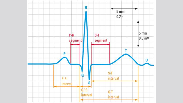 ECG signal from lead 1