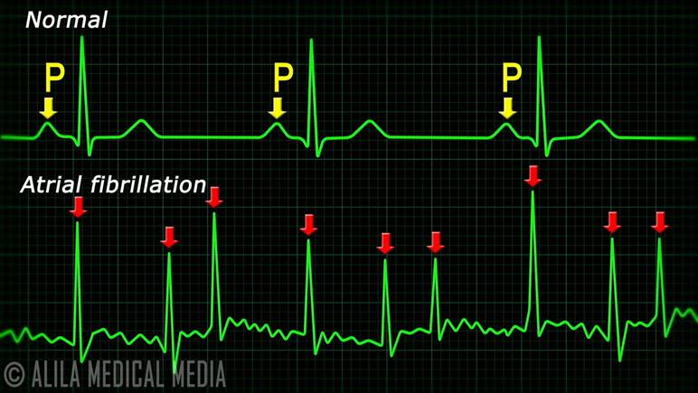 Image result for atrial fibrillation ecg